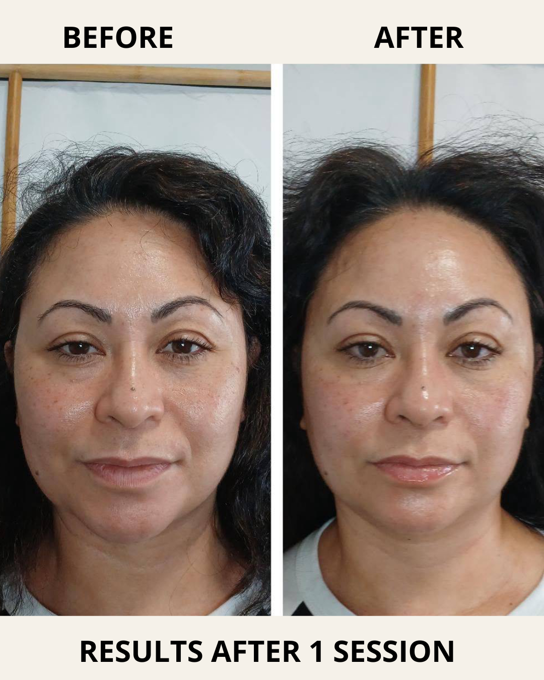 Treatment demonstration