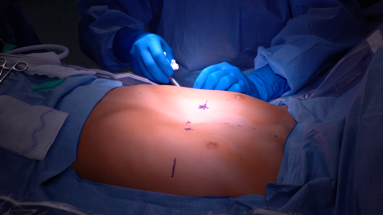 pectus excavatum surgery