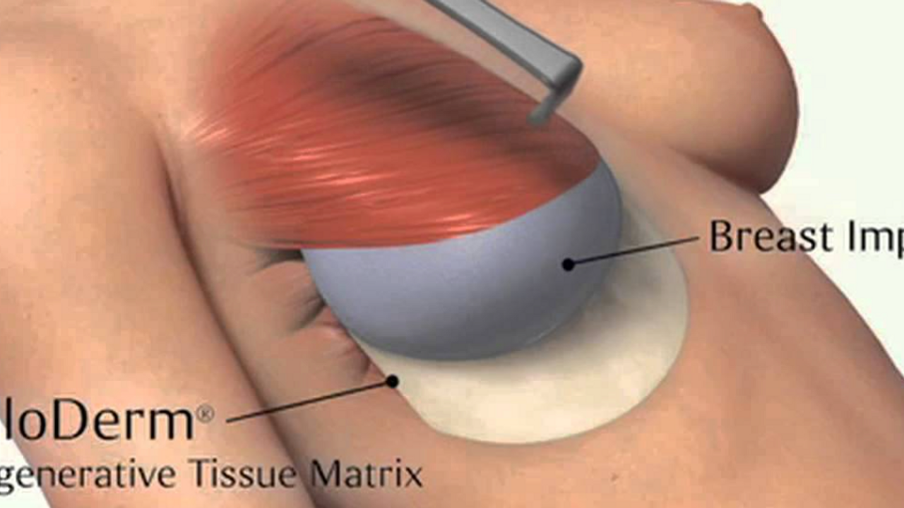 What is a Skin Island and How is it Used in Breast Reconstruction