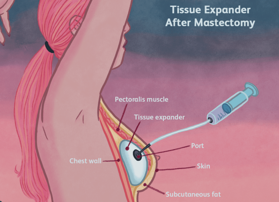 What is a Skin Island and How is it Used in Breast Reconstruction