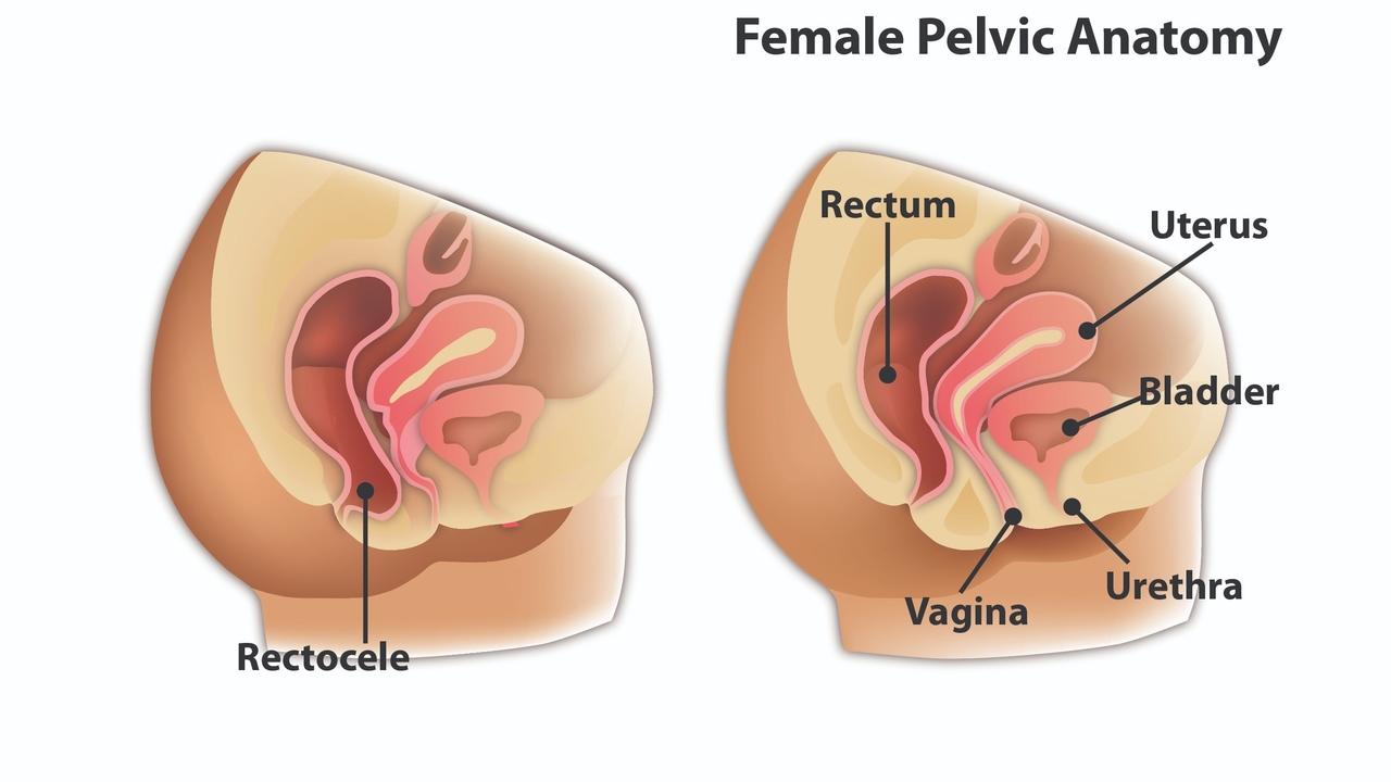 prolapsed bladder repair