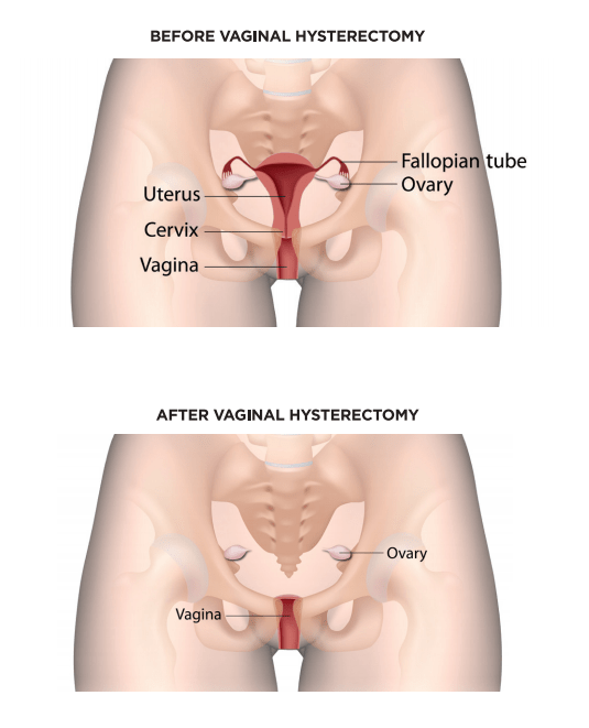 Vaginal Hysterectomy and Pelvic Floor Repair Surgery