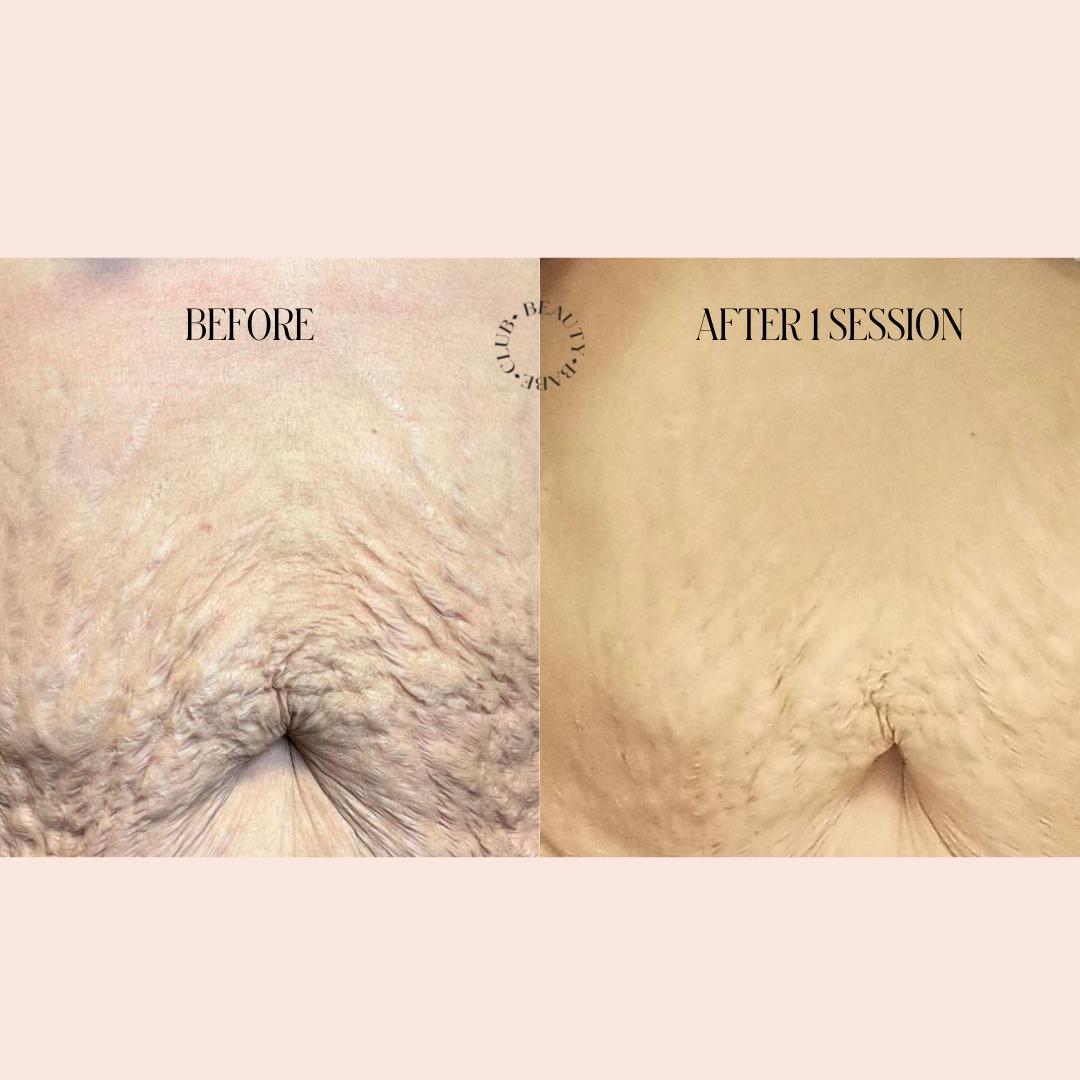 All You Need To Know About Inkless Stretch Mark Removal