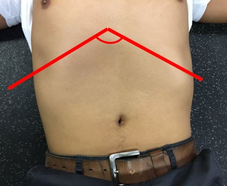 Structural vs Functional Infrasternal Angle Considerations –