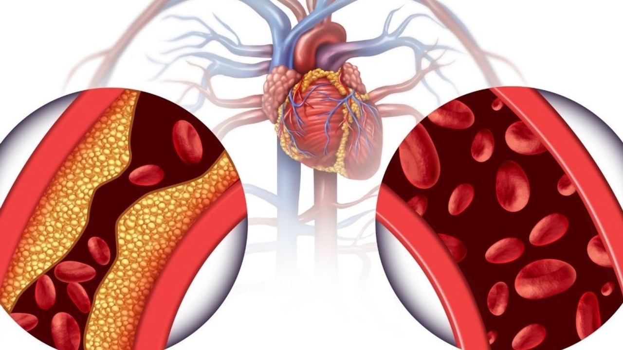 The Controversy of Cholesterol and Heart Disease