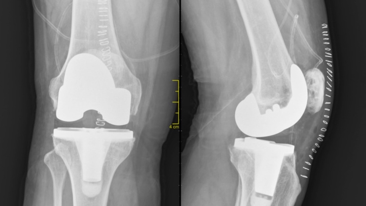 Knee-replacement-xray