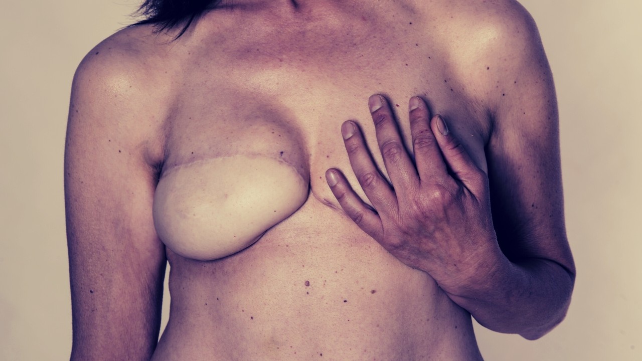 breast cancer