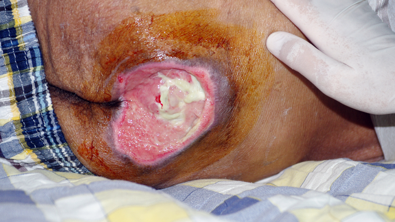 stage 1 pressure ulcer