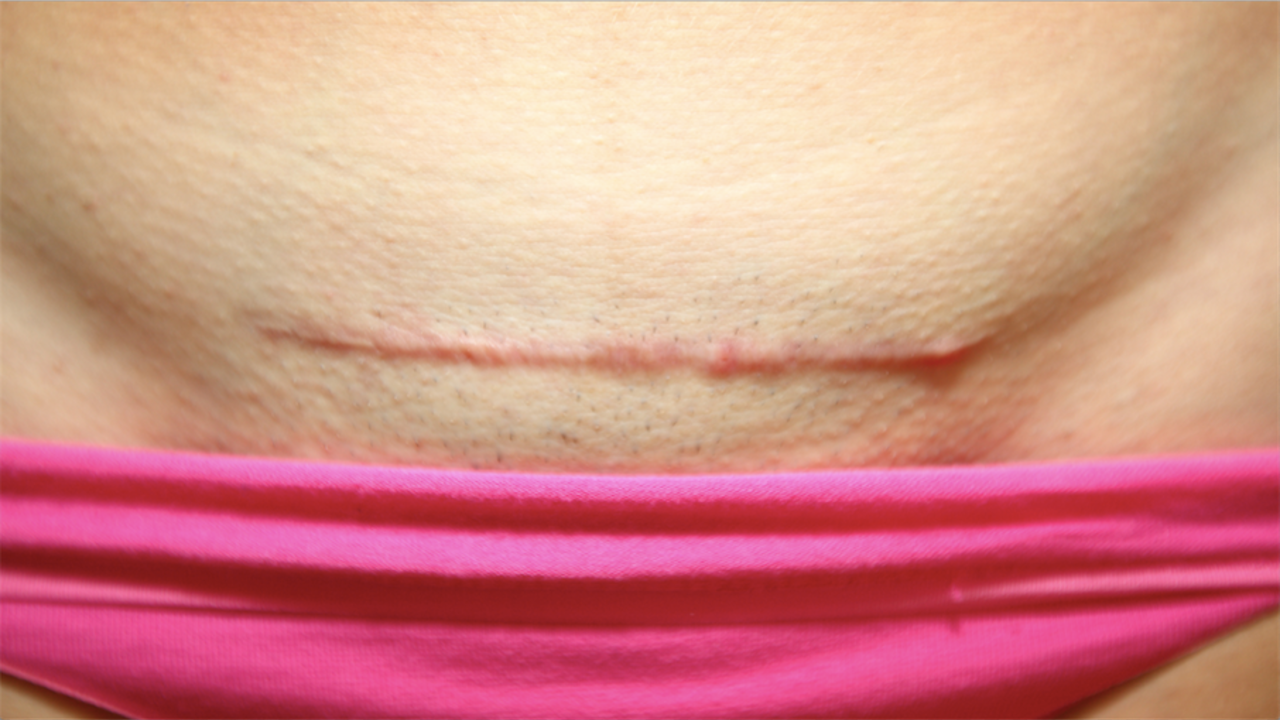 Say Goodbye to C-Section Scars: Comprehensive Removal Patch Guide