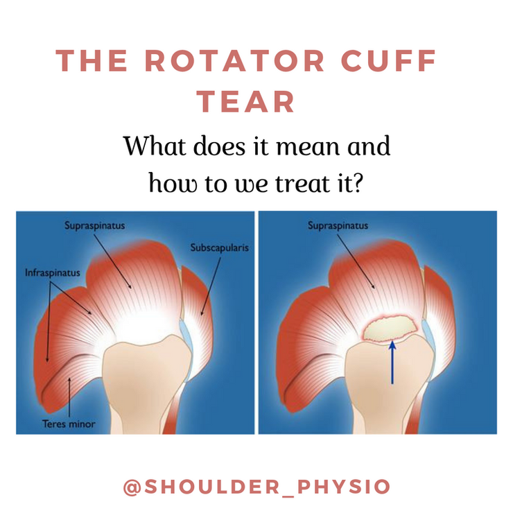 Types of Rotator Cuff Tears