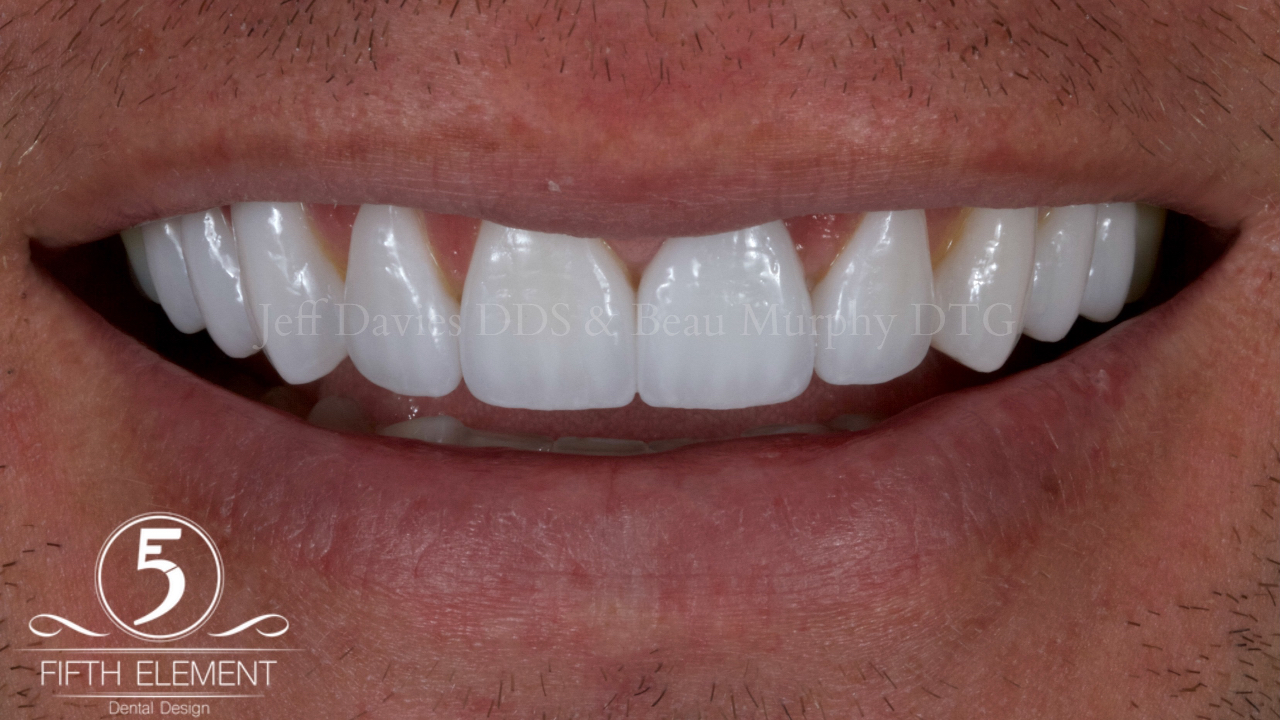 Natural cosmetic dentistry veneers in Dallas with lifelike translucency