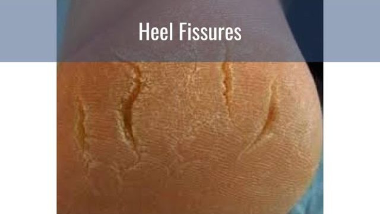 Heel Fissure Treatment Process