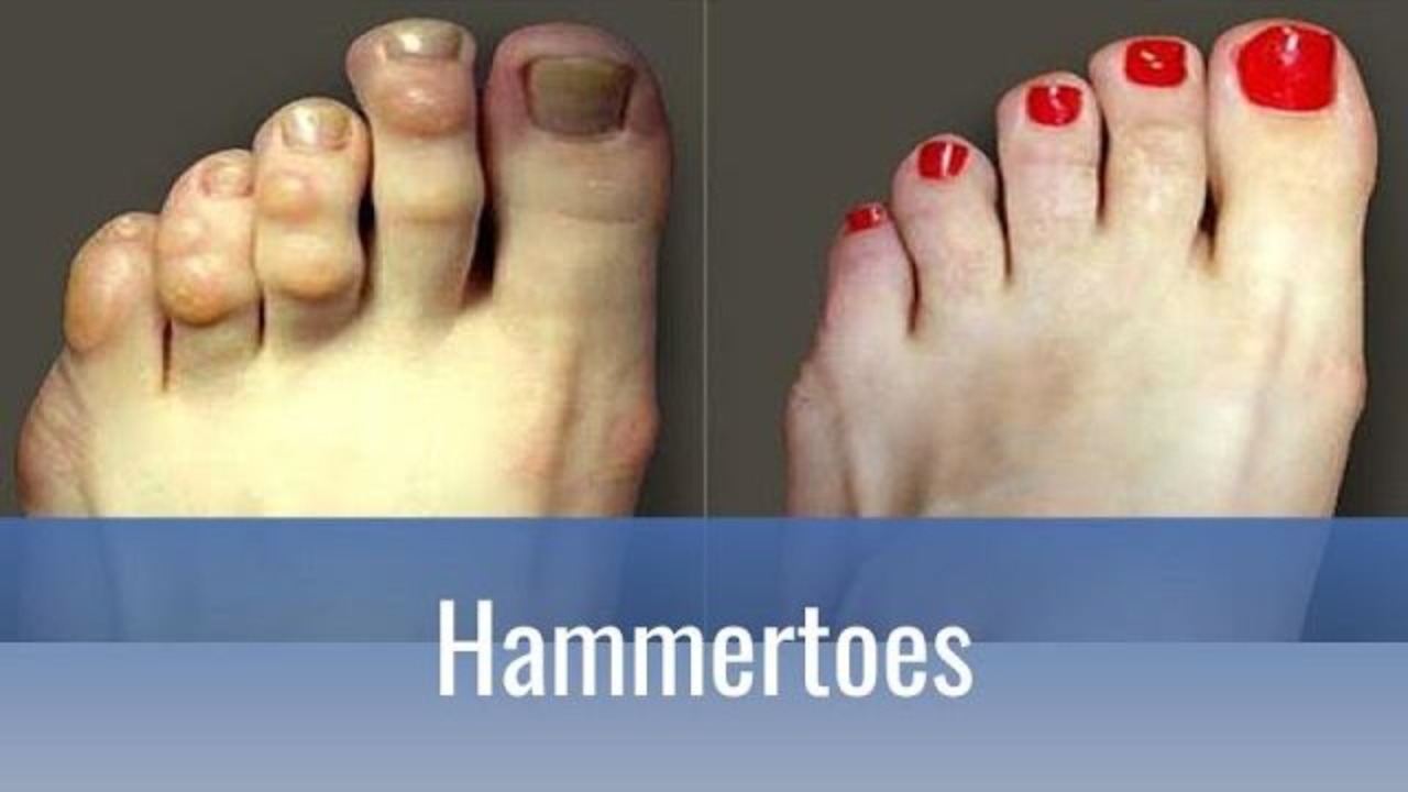 Hammertoe Treatment Process