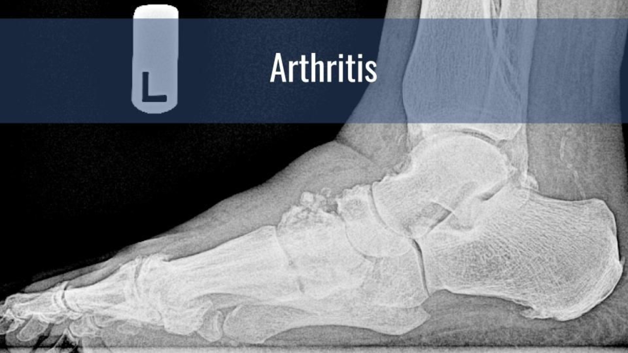 Midfoot Arthritis Treatment Process