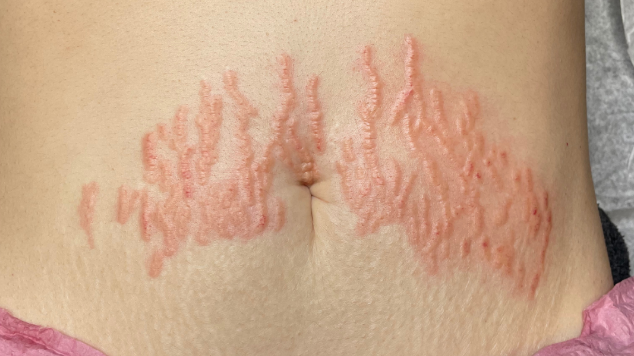 How Does Medical Tattooing for Stretch Marks Work? - Reflective Beauty  Boutique