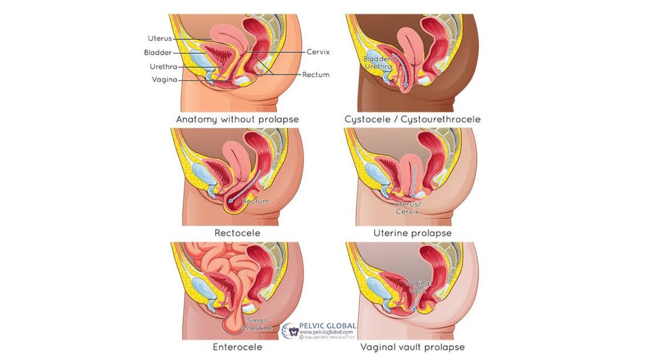 A Guide to Pelvic-Organ Prolapse: What is it? What are my