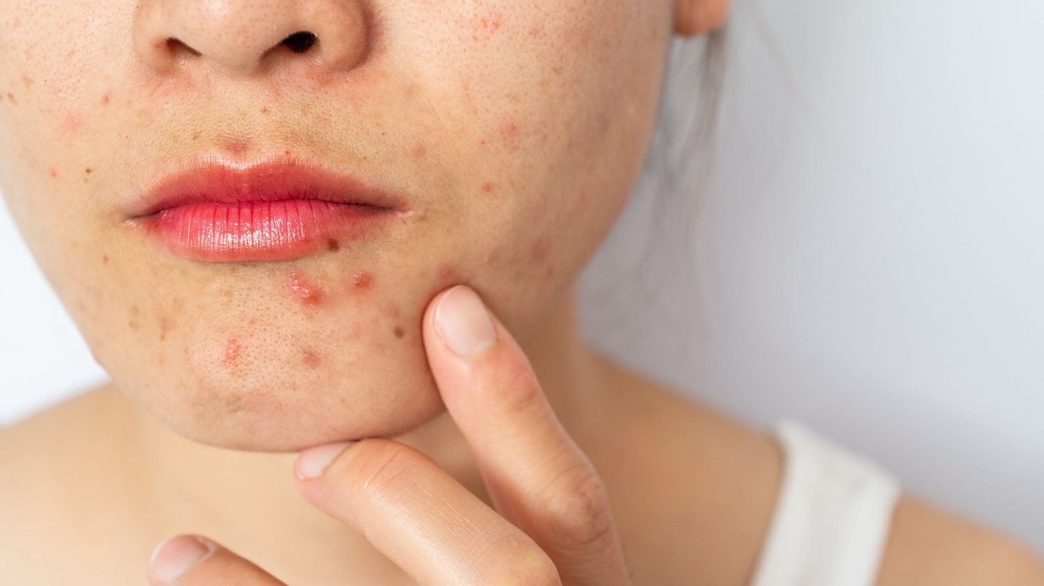 hormonal acne