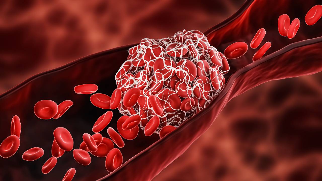 Medical illustration of a blood clot or thrombus blocking the red blood cell stream within a blood vessel.