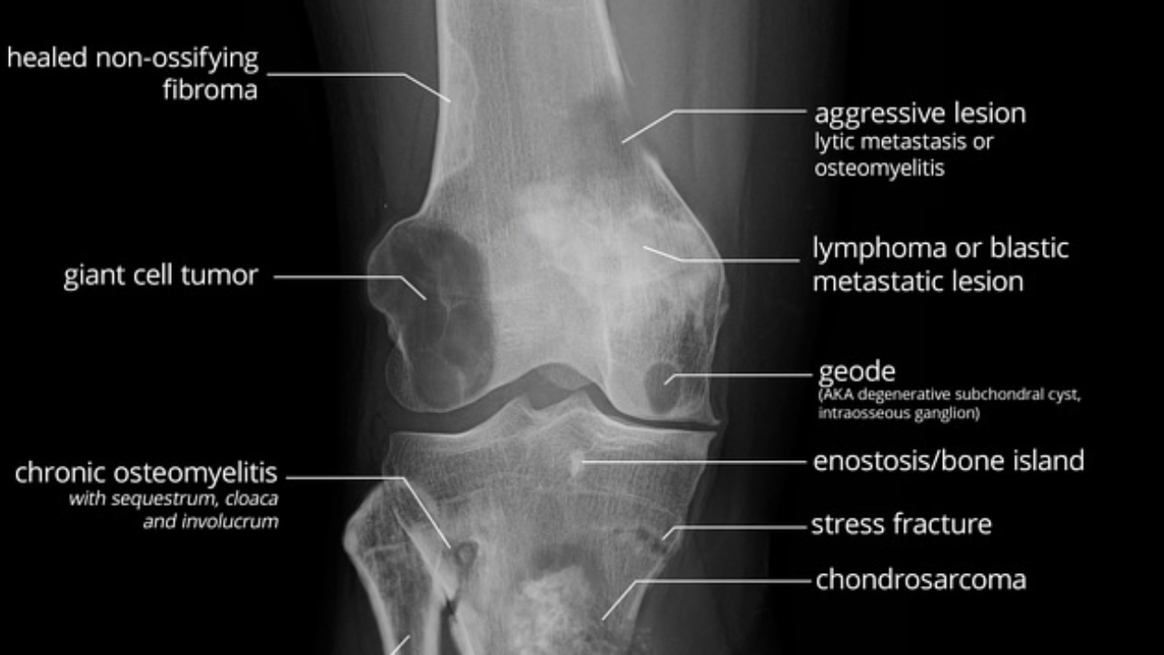 tumor xray for NBCE chiropractic board exam review