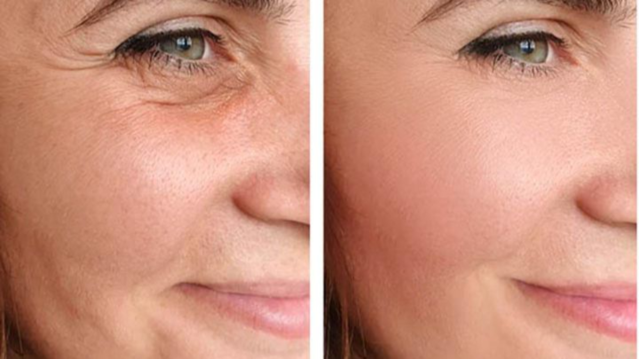 non-surgical face lift