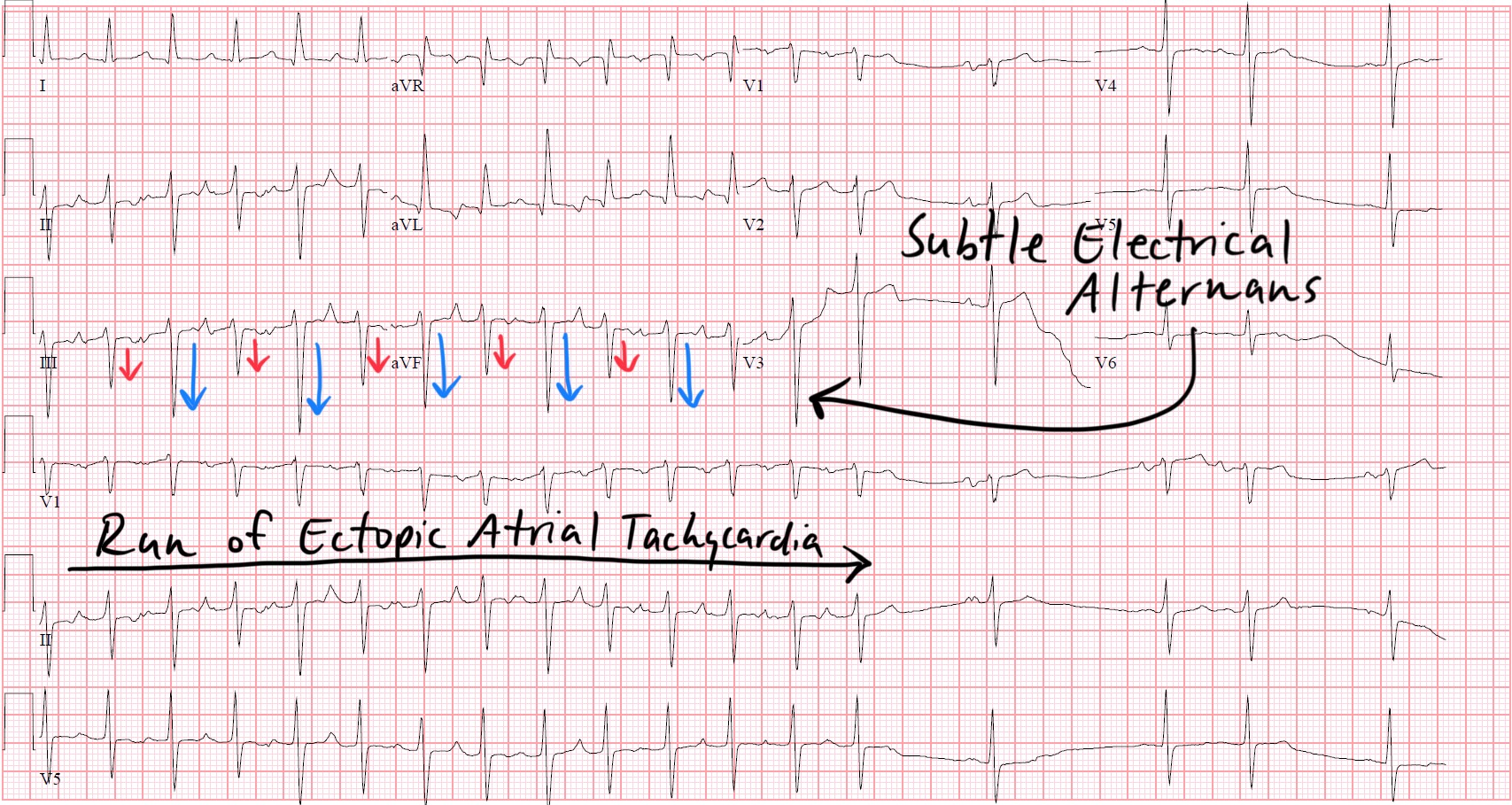 Pericardial Effusion Ecg Alternans