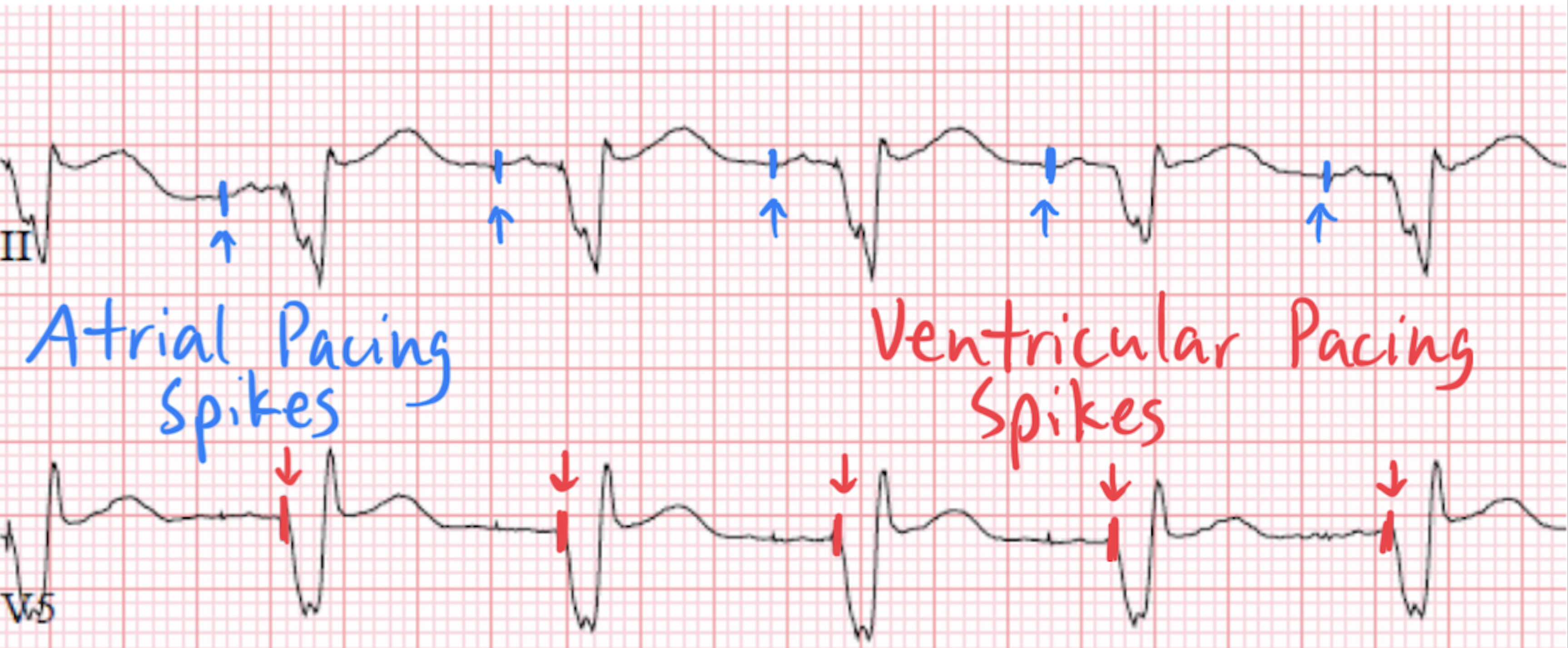 Dual AV Pacing Patterns Understanding Atrial Ventricular Pacing