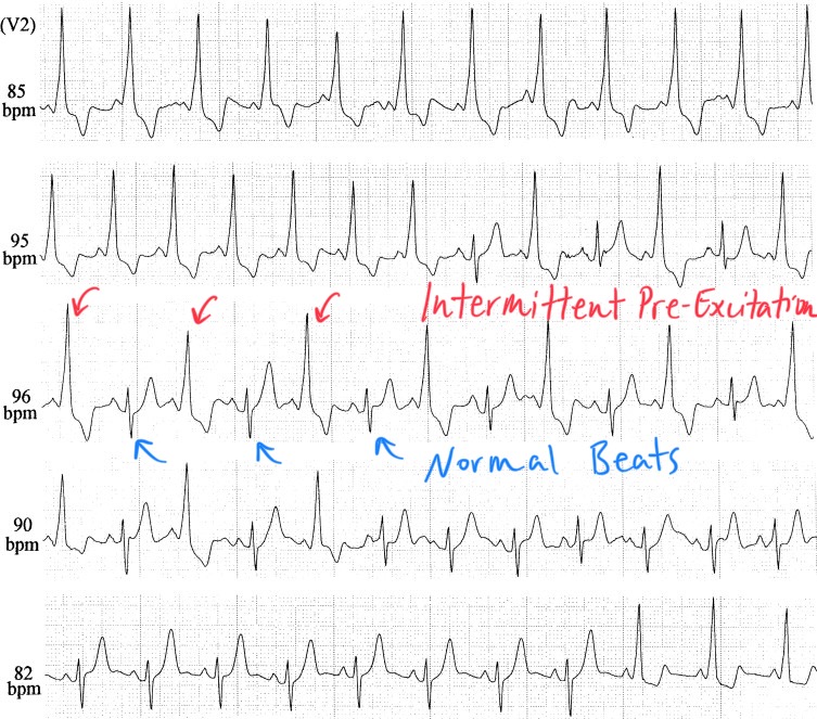 Pericardial Effusion Ecg Electrical Alternans