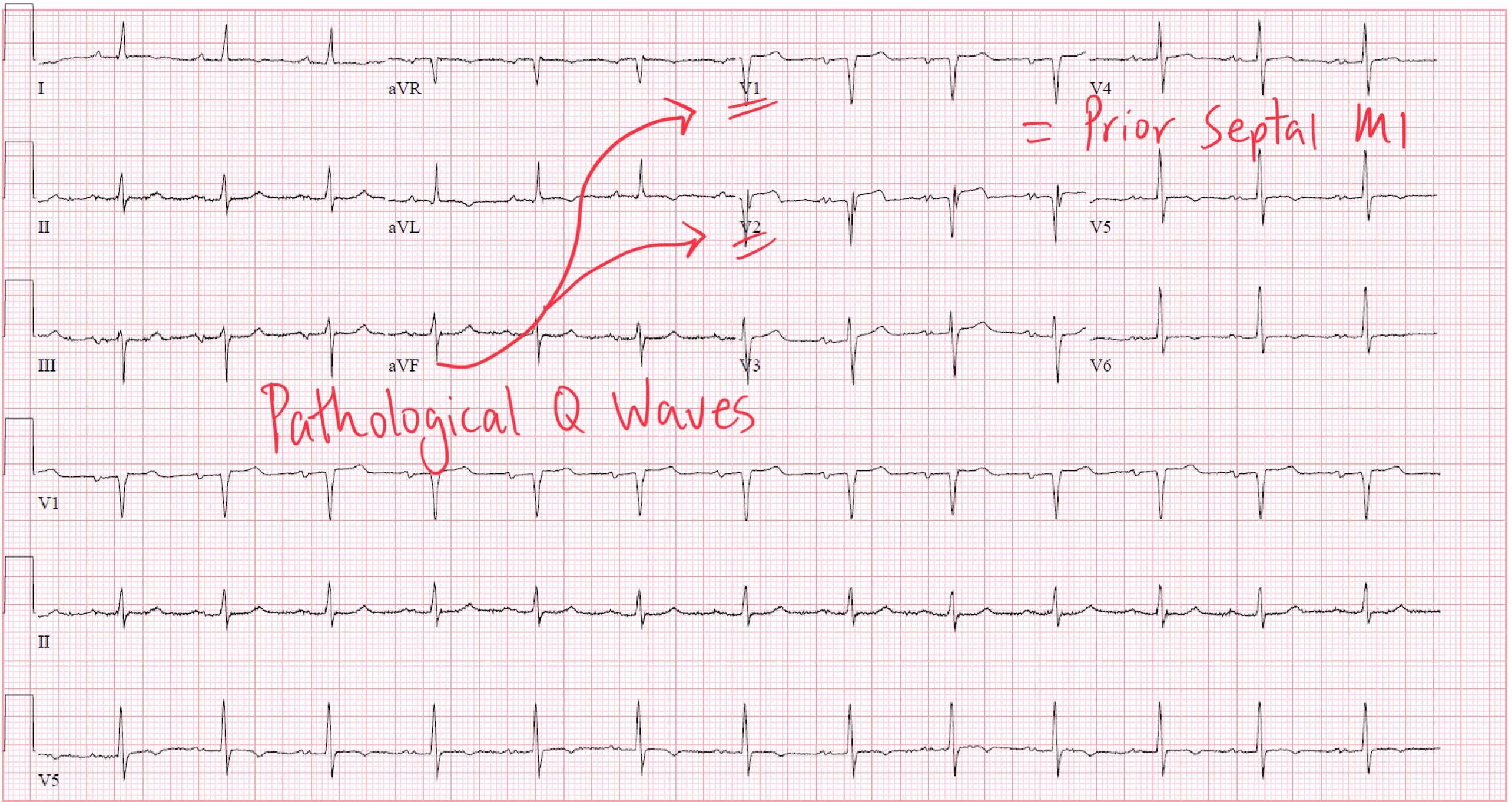 The Anatomy Of Pathological Q Waves On ECG