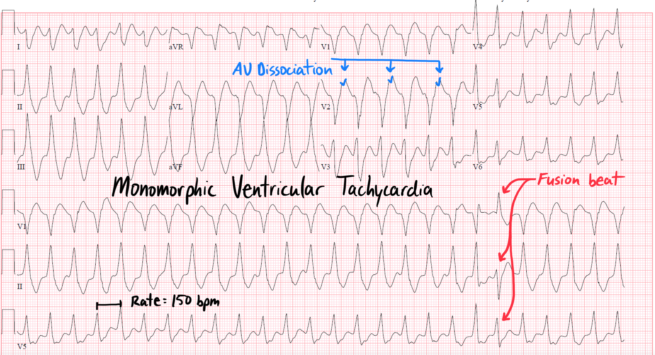 AV Dissociation A Specific ECG Finding For Ventricular Tachycardia AV Dissociation A Specific ECG Finding For Ventricular Tachycardia