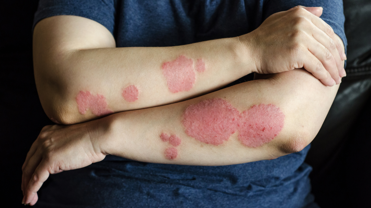 Eczema treatment balancing medication and lifestyle for skin relief