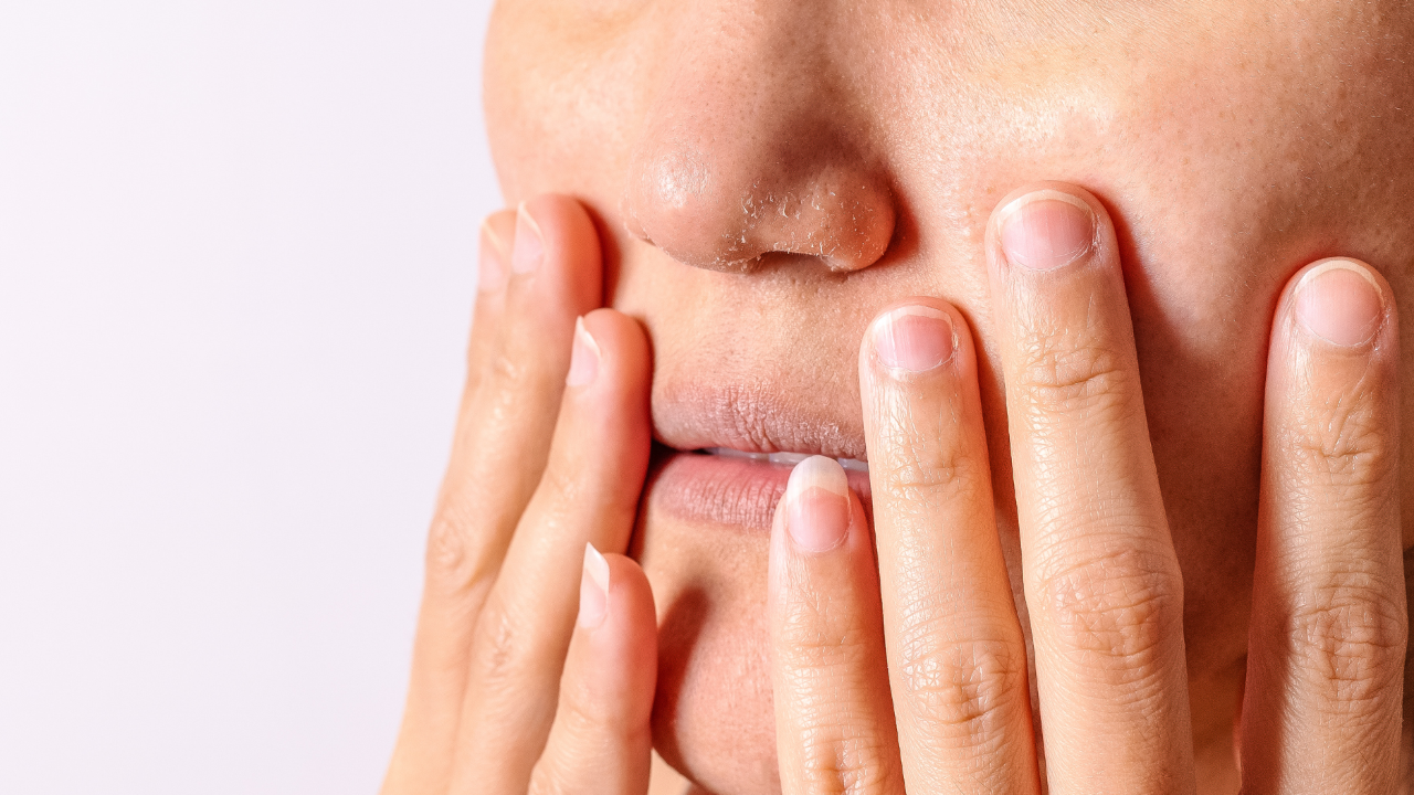 How to manage winter eczema flares