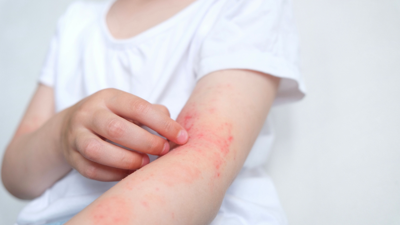 Eczema Healing Stages & Timeline