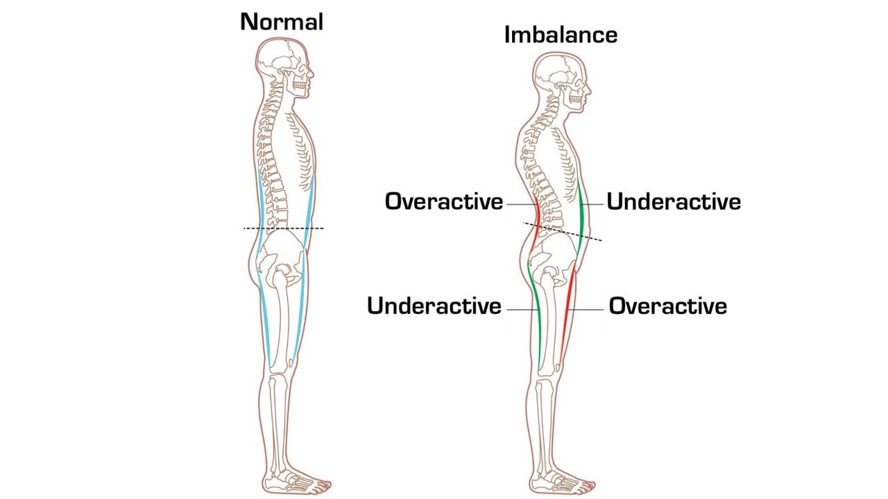 musculoskeletal diagram showing a muscle imbalance