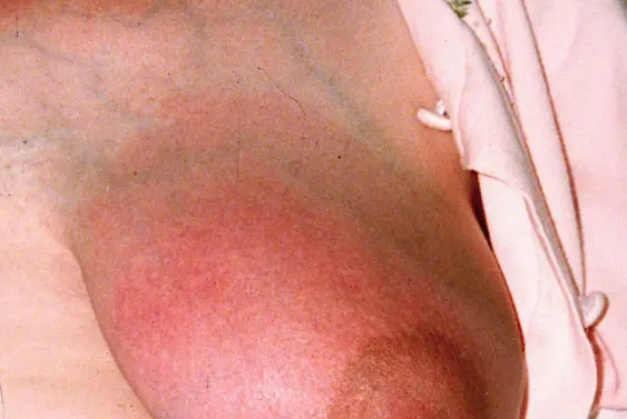  Inflamed, red area of the breast 