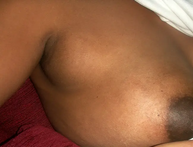  A woman with breast engorgement