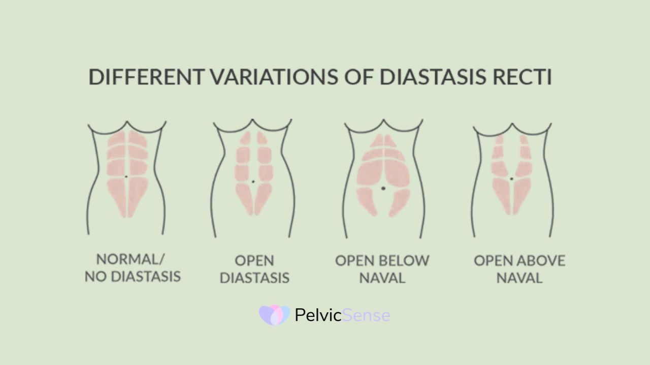 What Is Diastasis Recti?
