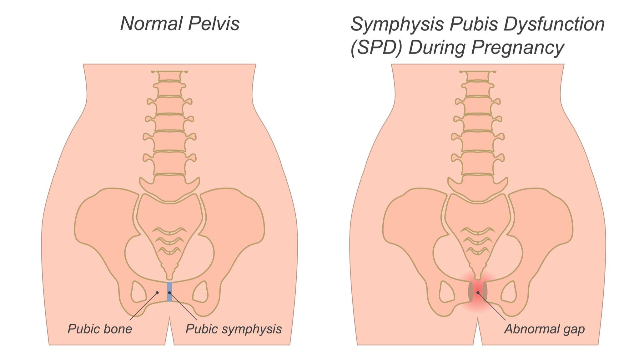Kobieta w ciąży z bólem miednicy i spojenia łonowego – ilustracja PGP w ciąży