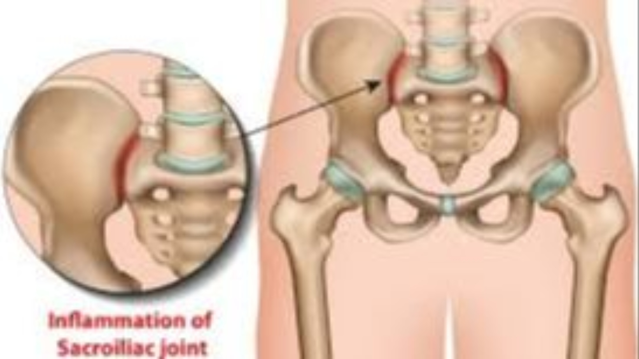 ból stawu krzyżowo-biodrowego lokalizacja w pośladku i dolnych plecach