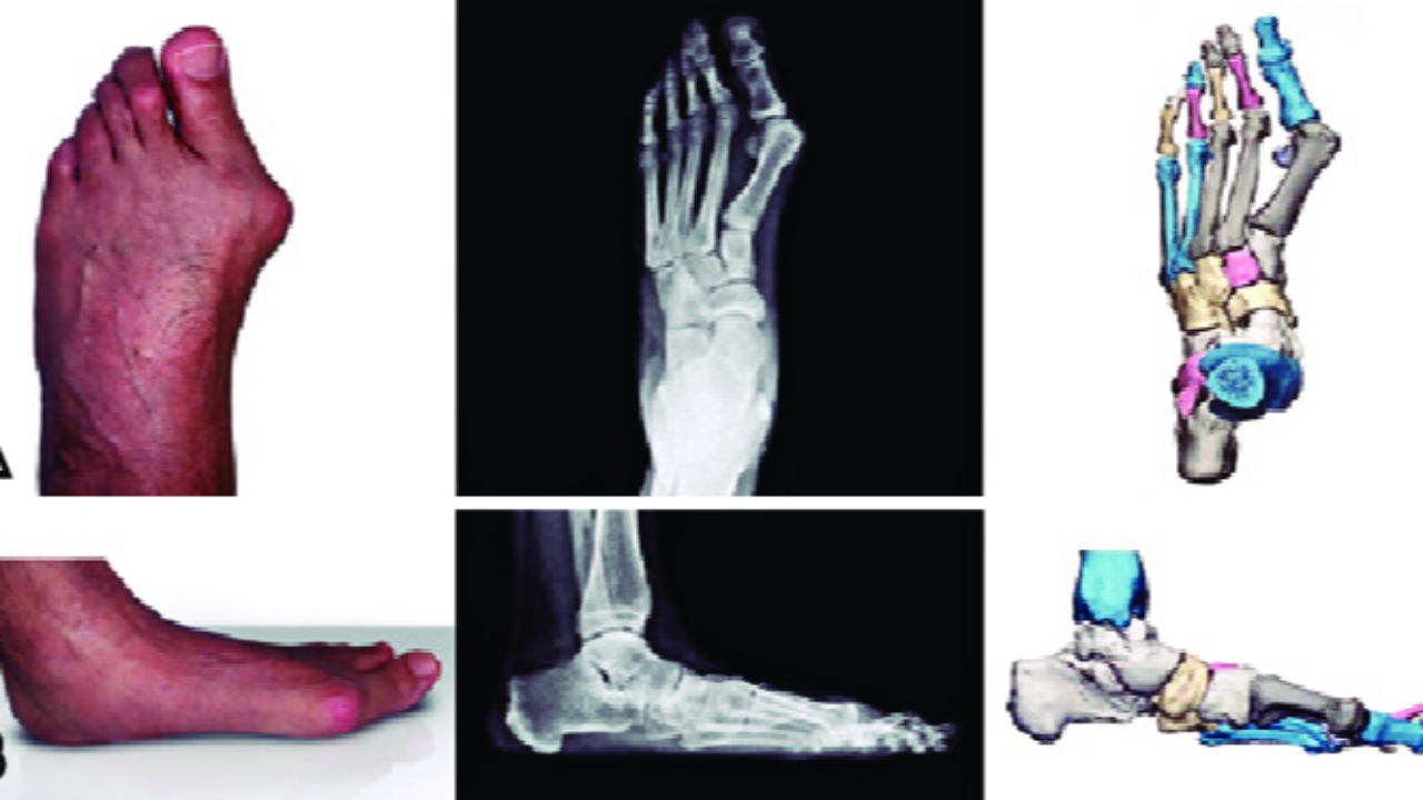 biomechanika odwodziciela palucha