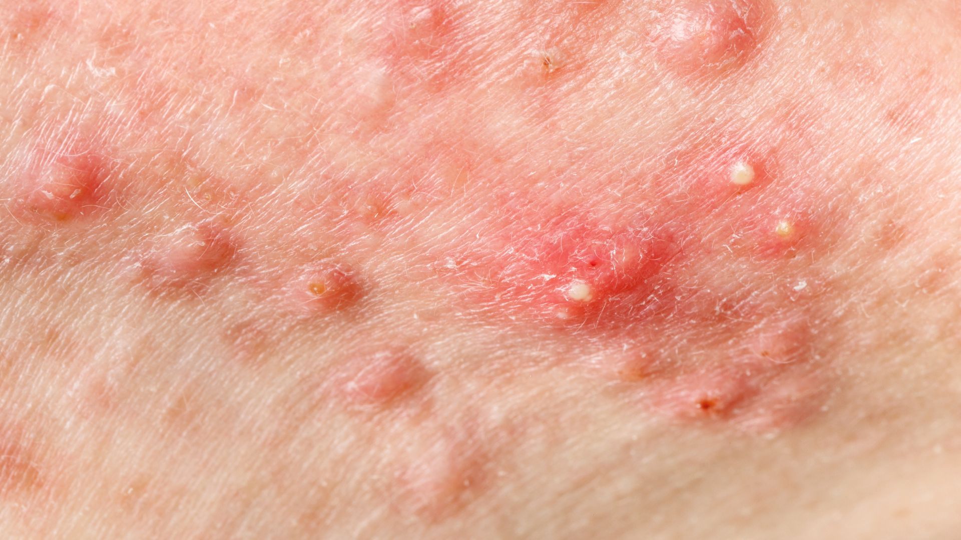 What to eat to cure acne