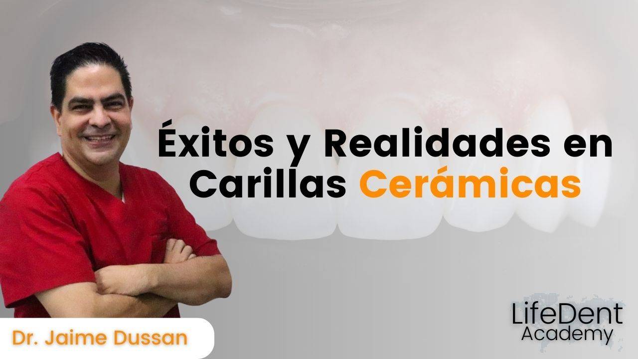 Éxitos y realidades en carillas cerámicas