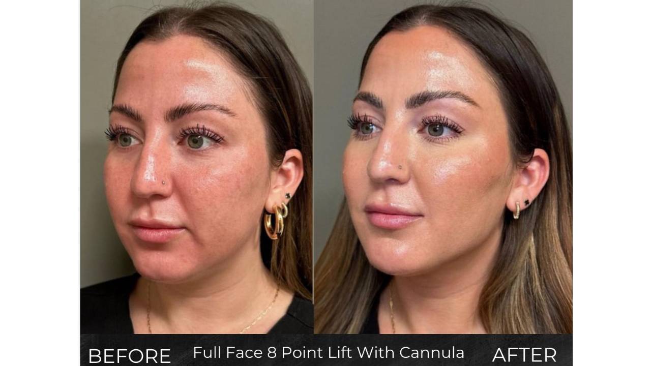 Full Face 8-Point Lift with Cannula and Needle