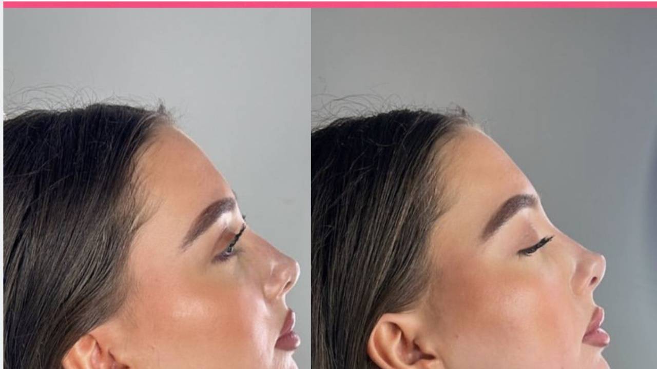 Non-Surgical Rhinoplasty