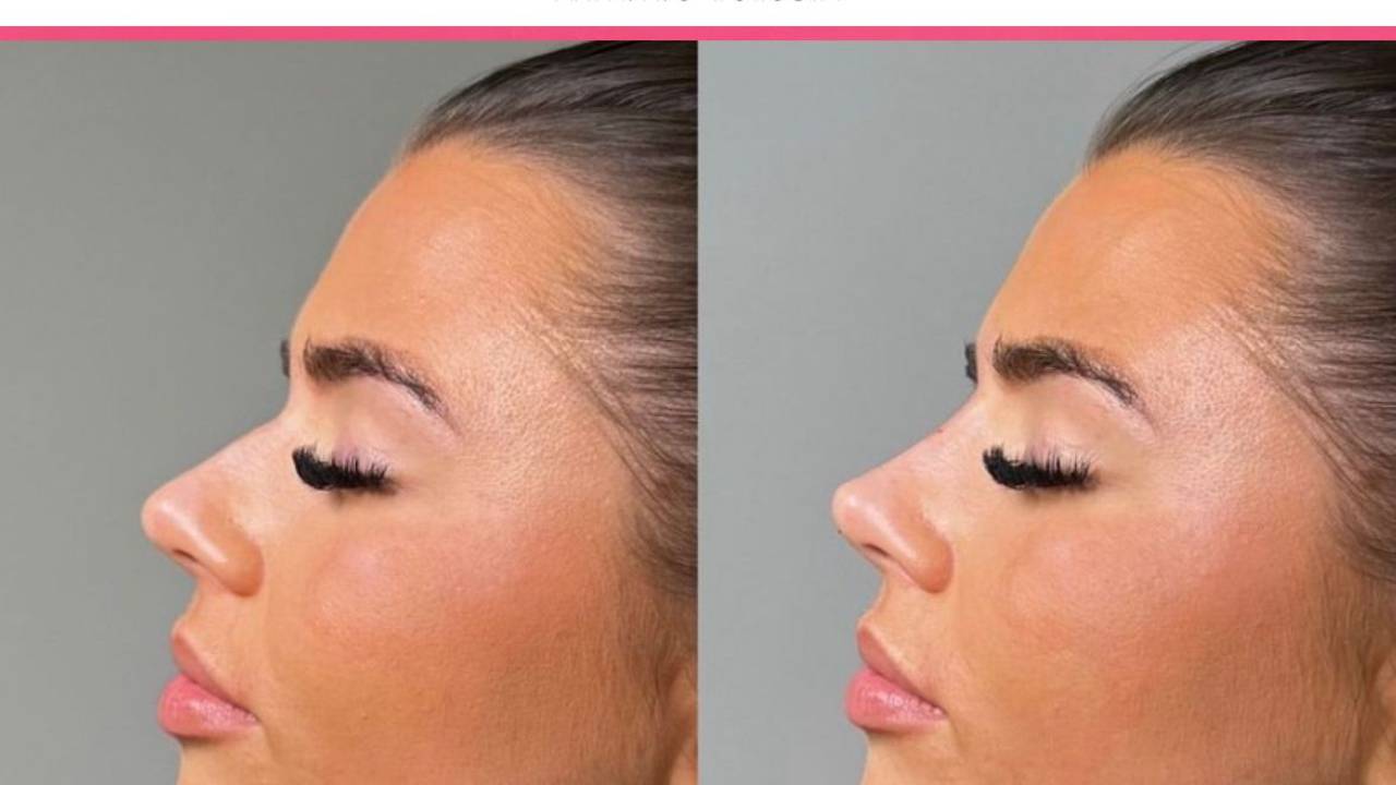 Pixie Tip Nose Lift