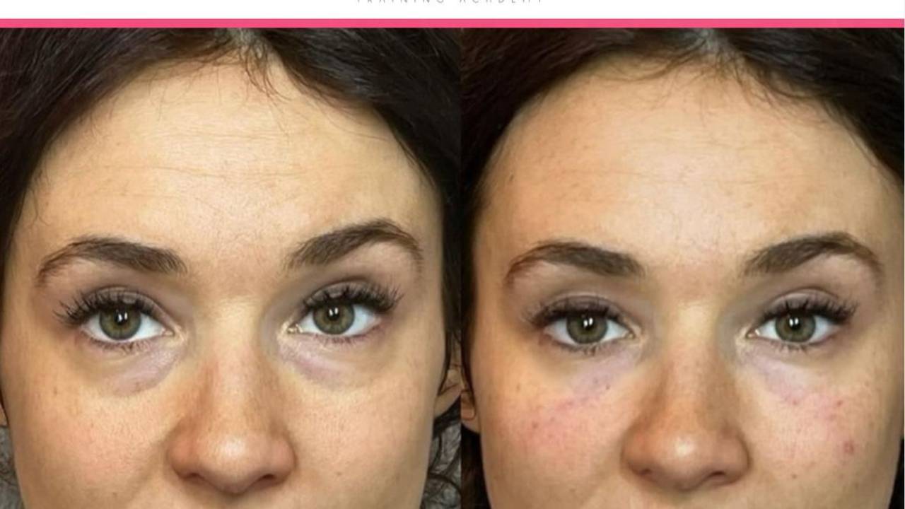 Tear Trough Filler Masterclass
