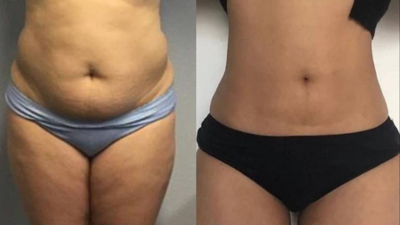 Lemon Bottle Fat-Dissolving