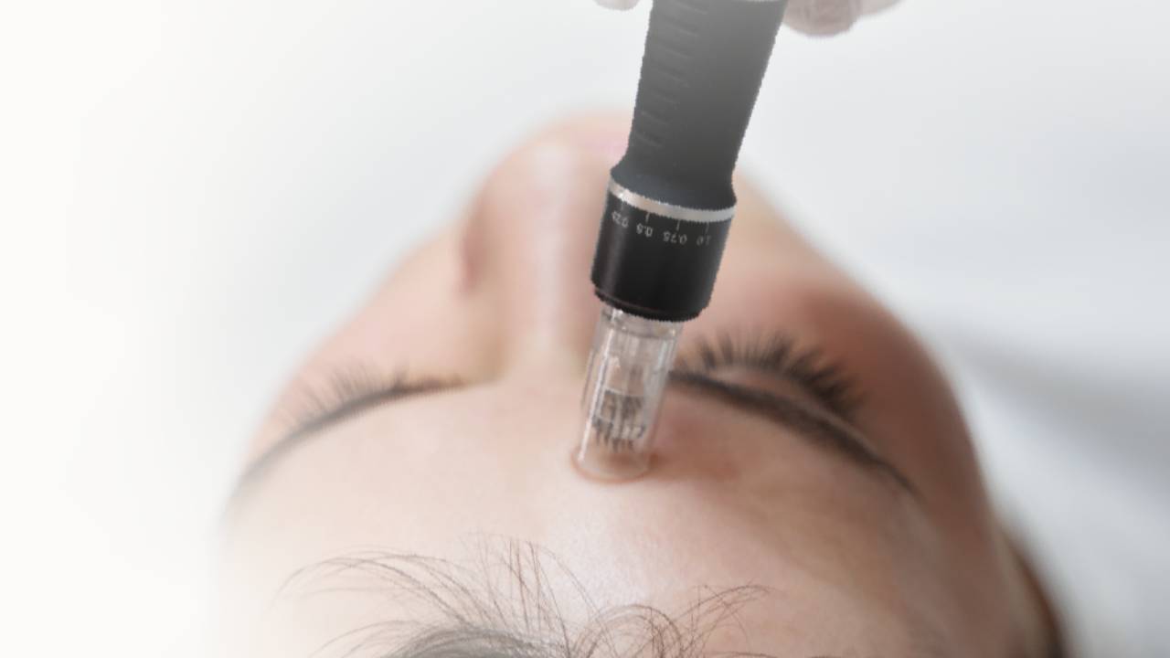 Microneedling Pro