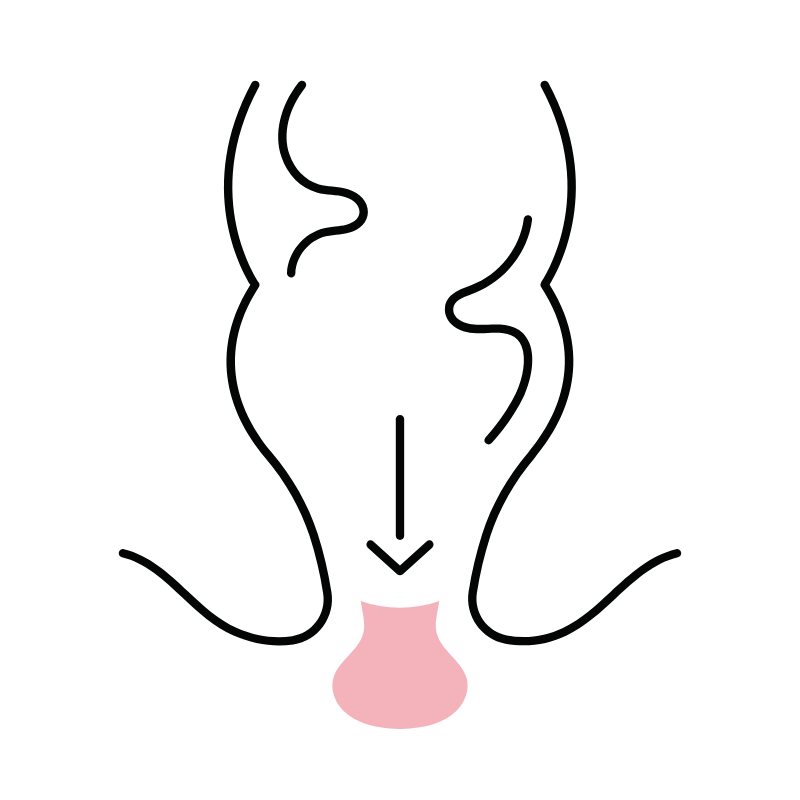 prolapse during pregnancy 