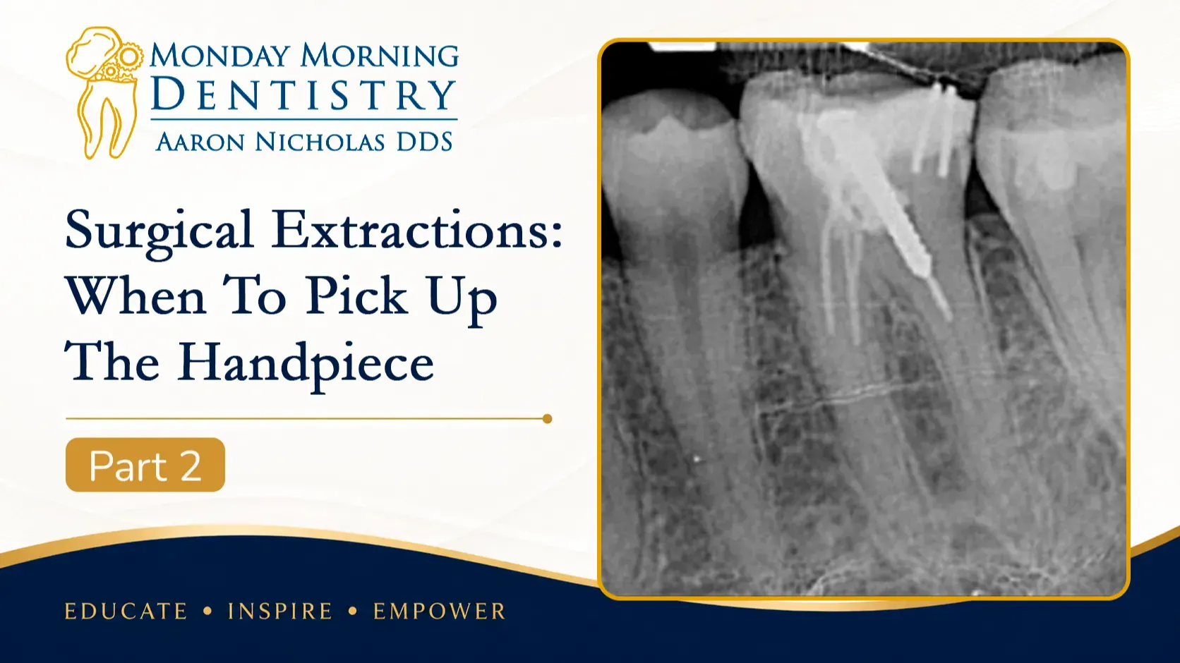 Surgical Extractions: When to Pick Up the Handpiece