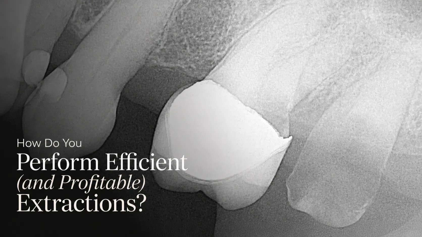 Dental extraction X-ray with title overlay for an efficient extraction case study